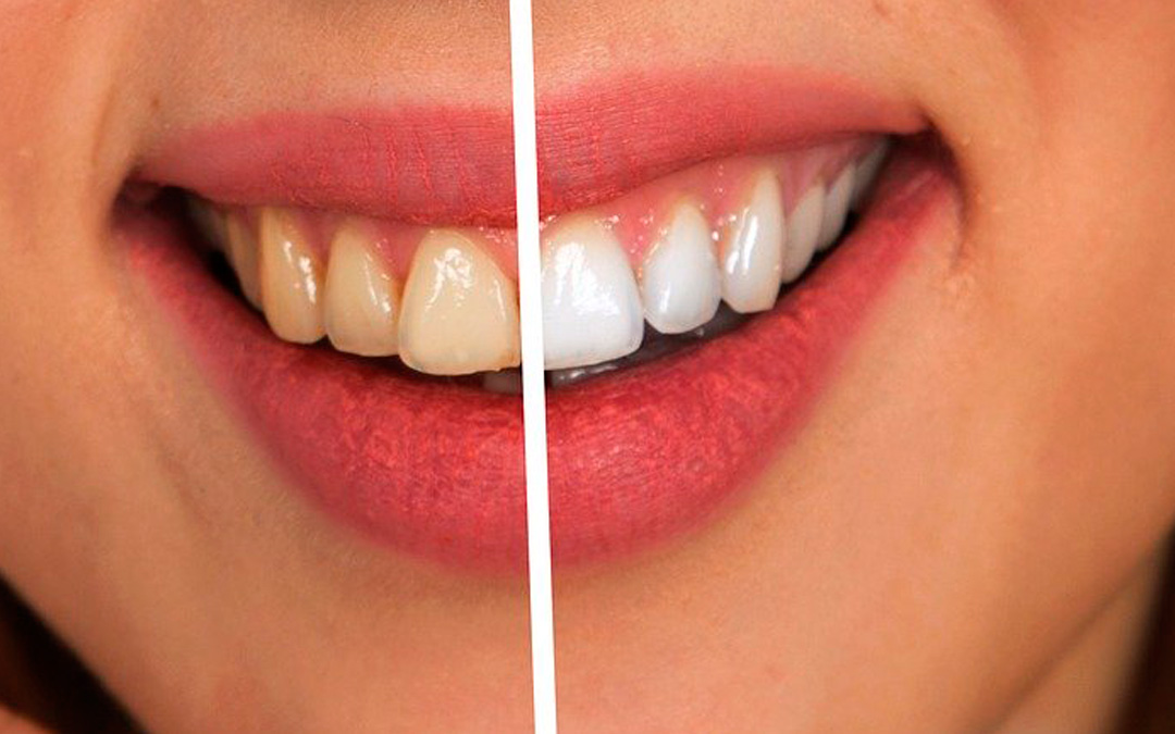 Compañero Salvación correcto Cómo tener los dientes blancos - maxilostetic