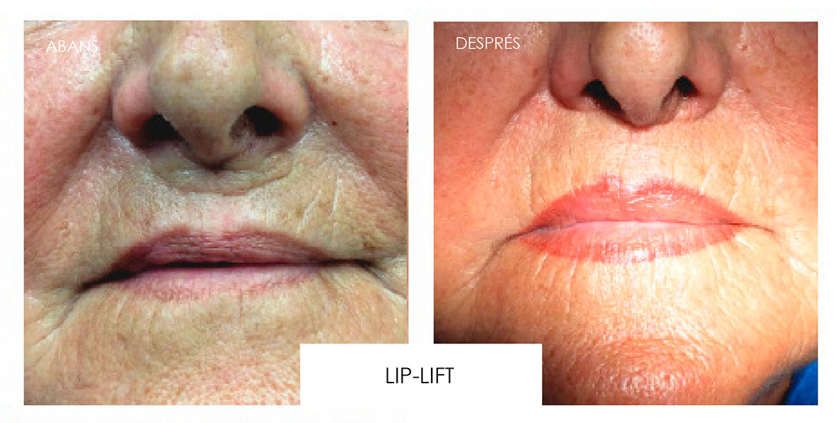Augment de llavi o Lip Fit?